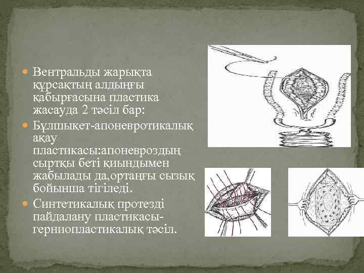  Вентральды жарықта құрсақтың алдыңғы қабырғасына пластика жасауда 2 тәсіл бар: Бұлшықет-апоневротикалық ақау пластикасы: