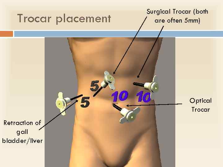 Trocar placement Surgical Trocar (both are often 5 mm) Optical Trocar Retraction of gall