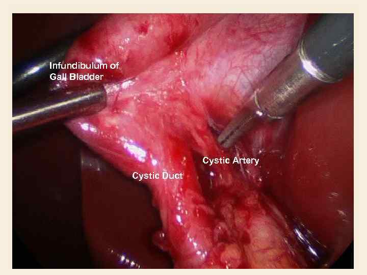 Infundibulum of Gall Bladder Cystic Artery Cystic Duct 