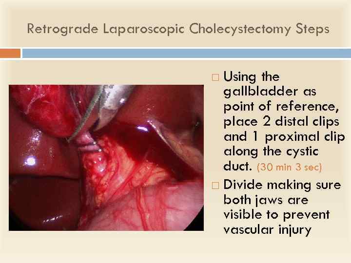 Retrograde Laparoscopic Cholecystectomy Steps Using the gallbladder as point of reference, place 2 distal