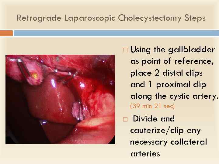 Retrograde Laparoscopic Cholecystectomy Steps Using the gallbladder as point of reference, place 2 distal