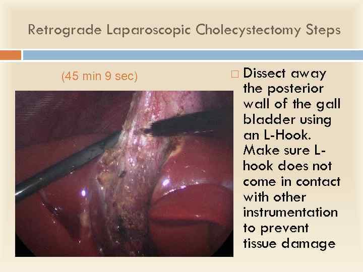 Retrograde Laparoscopic Cholecystectomy Steps (45 min 9 sec) Dissect away the posterior wall of