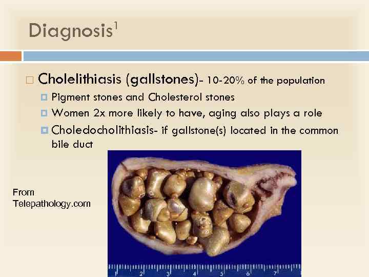 Diagnosis 1 Cholelithiasis (gallstones)- 10 -20% of the population Pigment stones and Cholesterol stones