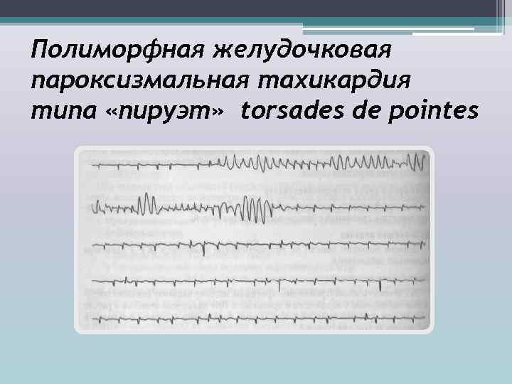 Полиморфная желудочковая пароксизмальная тахикардия типа «пируэт» torsades de pointes 