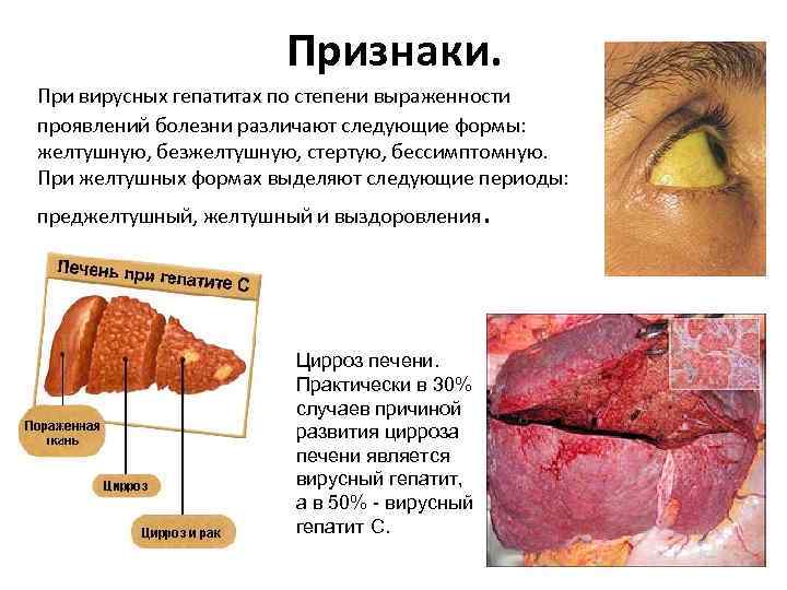 Признаки. При вирусных гепатитах по степени выраженности проявлений болезни различают следующие формы: желтушную, безжелтушную,