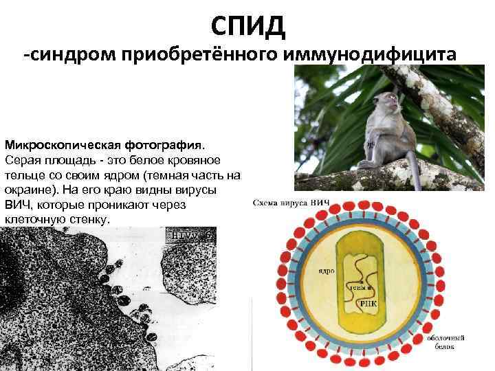 СПИД -синдром приобретённого иммунодифицита Микроскопическая фотография. Серая площадь - это белое кровяное тельце со