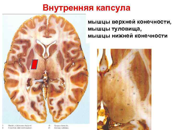 Bнутренняя капсула мышцы верхней конечности, мышцы туловища, мышцы нижней конечности 