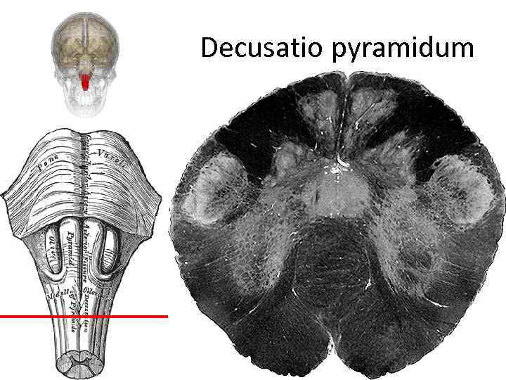 Decusatio pyramidum 