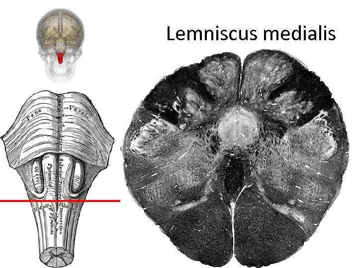 Lemniscus medialis 