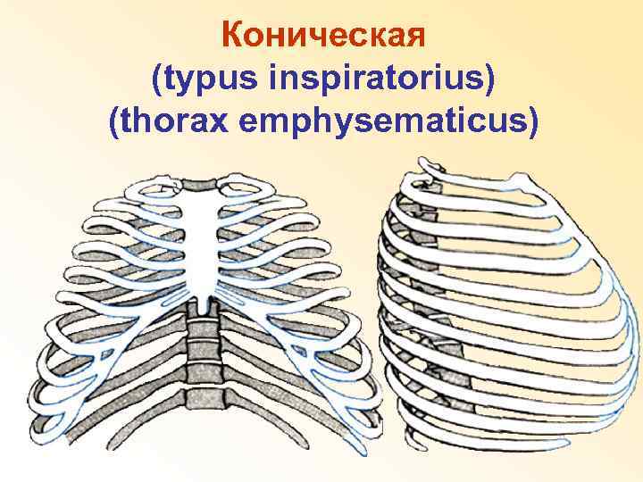 Коническая (typus inspiratorius) (thorax emphysematicus) 