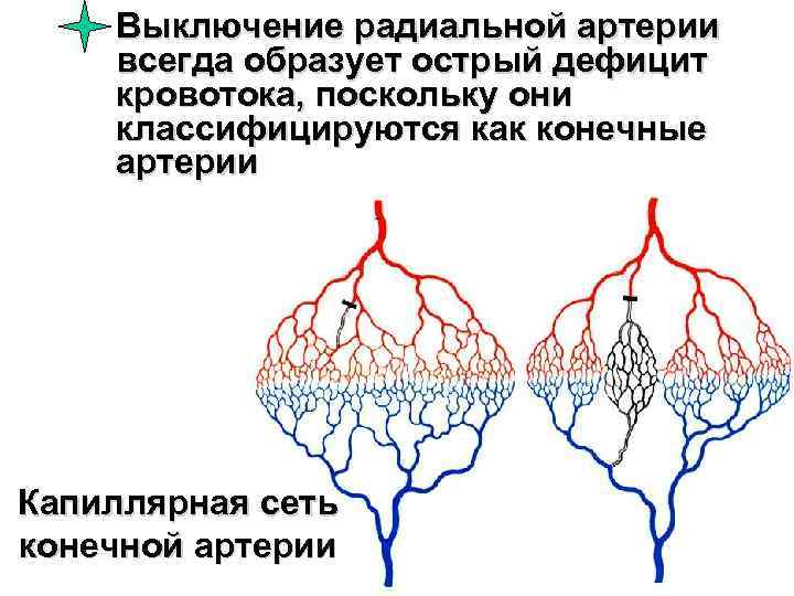 Выключение радиальной артерии всегда образует острый дефицит кровотока, поскольку они классифицируются как конечные артерии