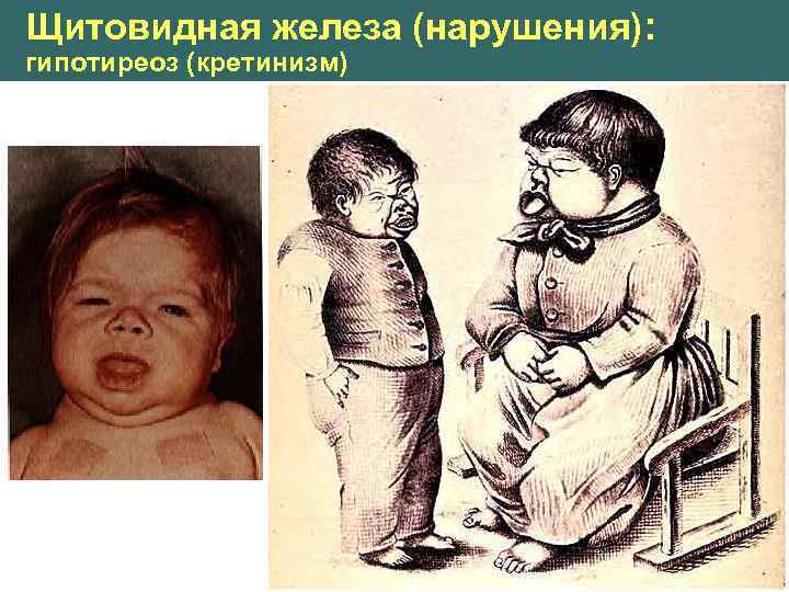Щитовидная железа (нарушения): гипотиреоз (кретинизм) 