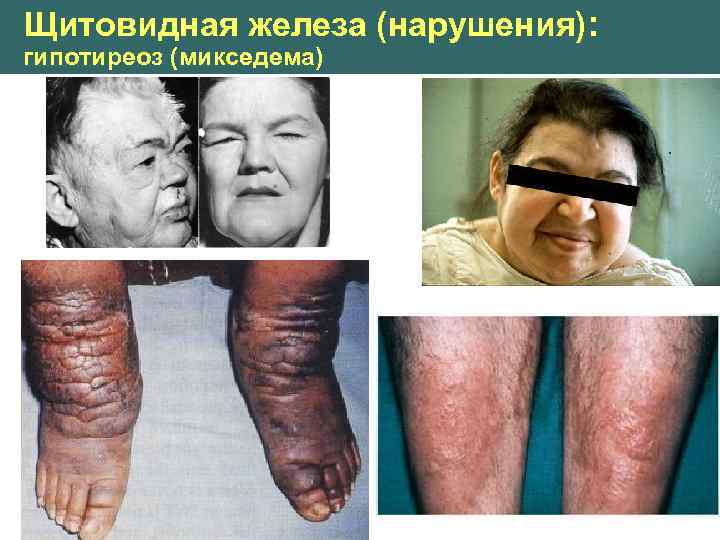 Щитовидная железа (нарушения): гипотиреоз (микседема) 