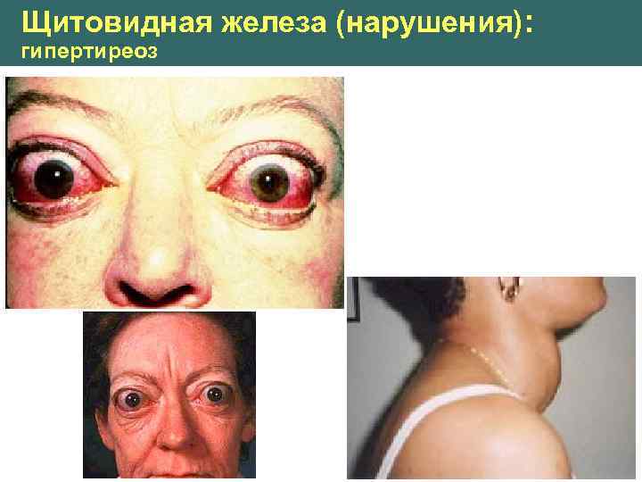 Щитовидная железа (нарушения): гипертиреоз 
