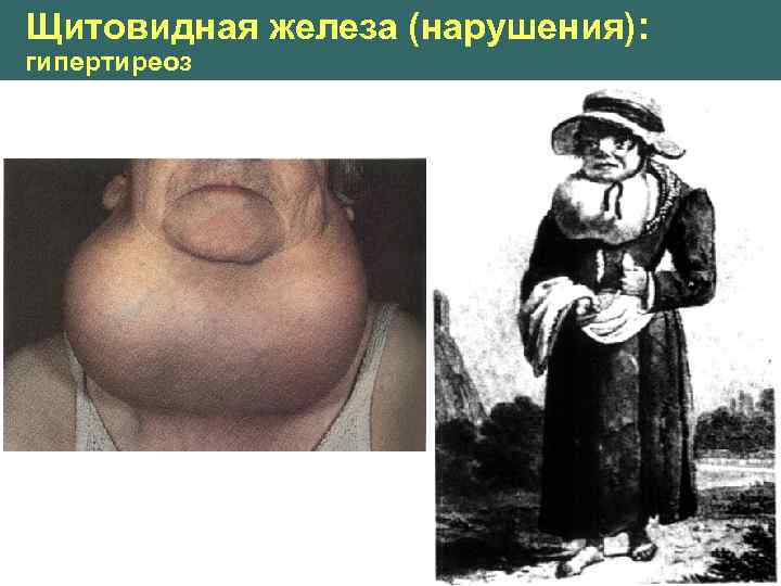 Щитовидная железа (нарушения): гипертиреоз 