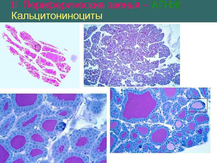 II Периферические звенья – АГНЖ Кальцитониноциты 