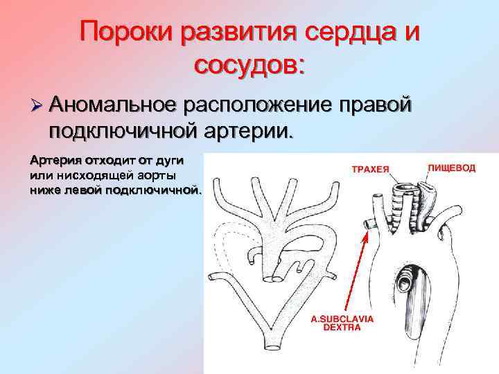 Правая аберрантная артерия. Аномальное расположение правой подключичной артерии. Аберрантная правая подключичная артерия. Аномалии развития артерий и вен. Аномальное расположение сердца.