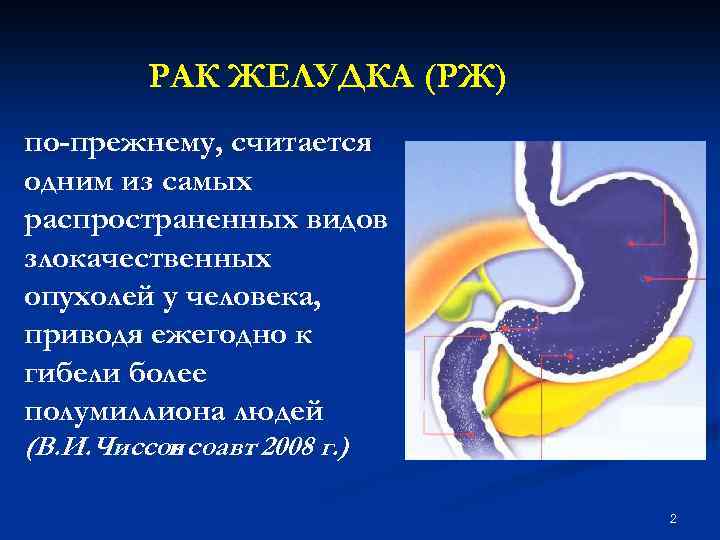 РАК ЖЕЛУДКА (РЖ) по-прежнему, считается одним из самых распространенных видов злокачественных опухолей у человека,