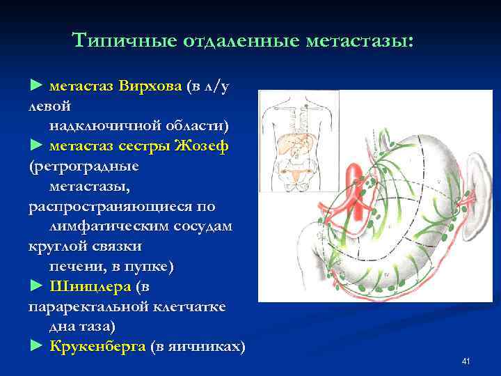 Типичные отдаленные метастазы: ► метастаз Вирхова (в л/у левой надключичной области) ► метастаз сестры