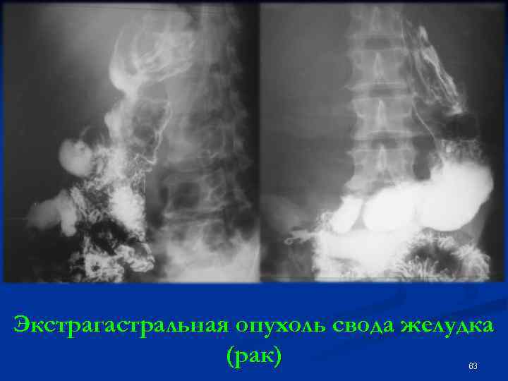 Экстрагастральная опухоль свода желудка (рак) 63 