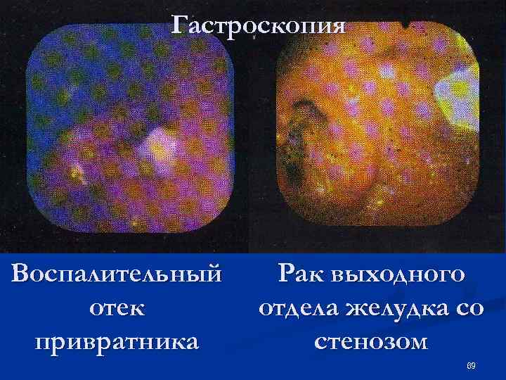 Гастроскопия Воспалительный отек привратника Рак выходного отдела желудка со стенозом 69 