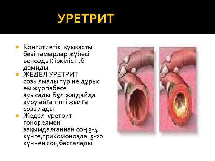 УРЕТРИТ Конгитивтік қуықасты безі тамырлар жүйесі веноздық іркіліс п. б дамиды. ЖЕДЕЛ УРЕТРИТ созылмалы