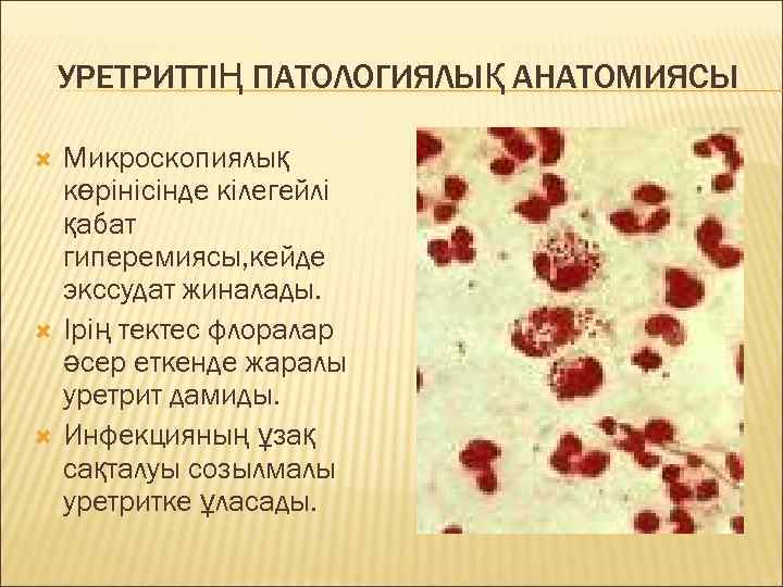 УРЕТРИТТІҢ ПАТОЛОГИЯЛЫҚ АНАТОМИЯСЫ Микроскопиялық көрінісінде кілегейлі қабат гиперемиясы, кейде экссудат жиналады. Ірің тектес флоралар