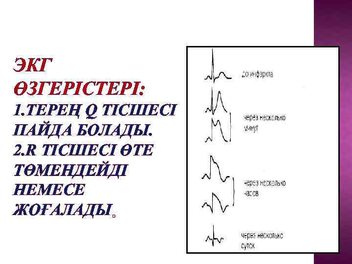 ЭКГ ӨЗГЕРІСТЕРІ: 1. ТЕРЕҢ Q ТІСШЕСІ ПАЙДА БОЛАДЫ. 2. R ТІСШЕСІ ӨТЕ ТӨМЕНДЕЙДІ НЕМЕСЕ