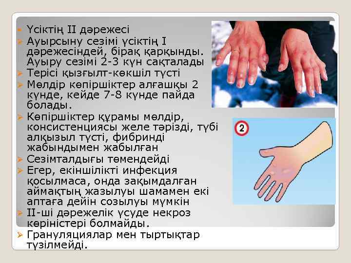 Үсіктің II дәрежесі Ауырсыну сезімі үсіктің I дәрежесіндей, бірақ қарқынды. Ауыру сезімі 2 -3