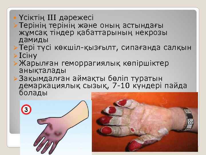  Үсіктің III дәрежесі Ø Терінің терінің және оның астындағы жұмсақ тіндер қабаттарының некрозы