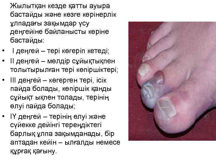  Жылытқан кезде қатты ауыра бастайды және көзге көрінерлік ұлпадағы зақымдар үсу деңгейіне байланысты
