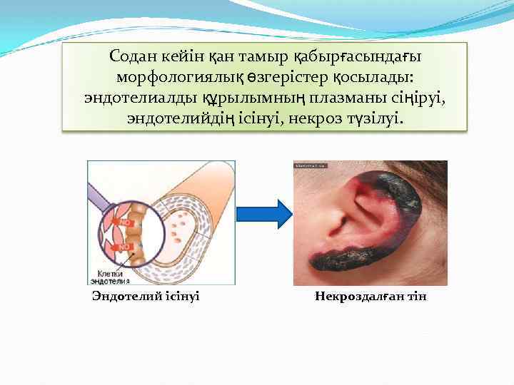 Содан кейін қан тамыр қабырғасындағы морфологиялық өзгерістер қосылады: эндотелиалды құрылымның плазманы сіңіруі, эндотелийдің ісінуі,