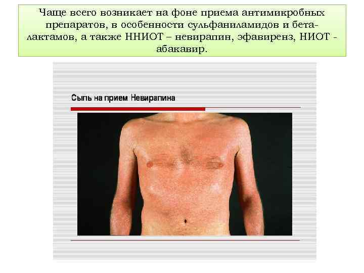 Чаще всего возникает на фоне приема антимикробных препаратов, в особенности сульфаниламидов и беталактамов, а