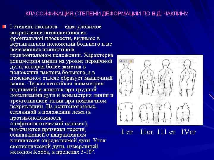 КЛАССИФИКАЦИЯ СТЕПЕНИ ДЕФОРМАЦИИ ПО В. Д. ЧАКЛИНУ I степень сколиоза— едва уловимое искривление позвоночника