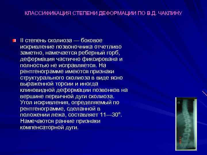 КЛАССИФИКАЦИЯ СТЕПЕНИ ДЕФОРМАЦИИ ПО В. Д. ЧАКЛИНУ II степень сколиоза — боковое искривление позвоночника