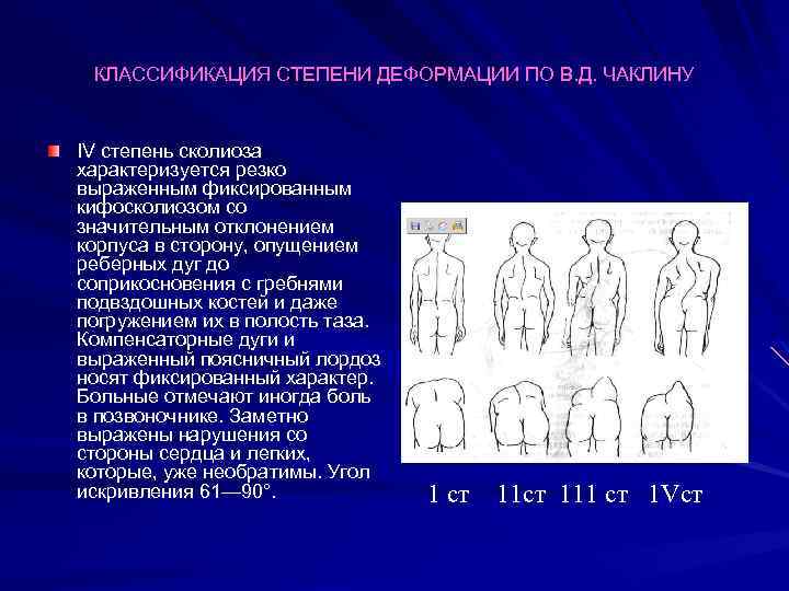 КЛАССИФИКАЦИЯ СТЕПЕНИ ДЕФОРМАЦИИ ПО В. Д. ЧАКЛИНУ IV степень сколиоза характеризуется резко выраженным фиксированным