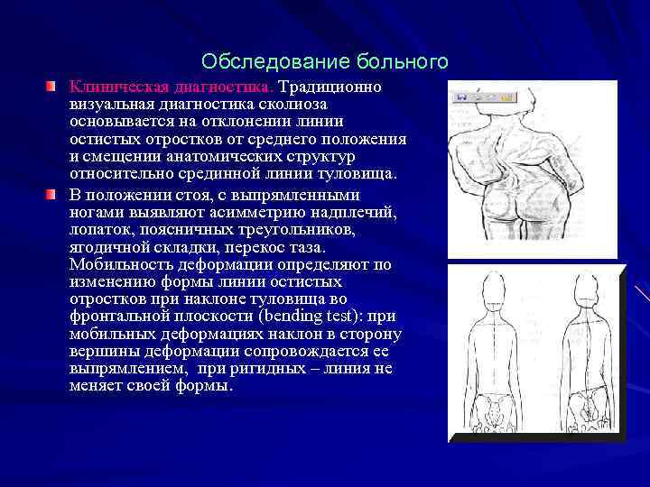 Обследование больного Клиническая диагностика. Традиционно визуальная диагностика сколиоза основывается на отклонении линии остистых отростков