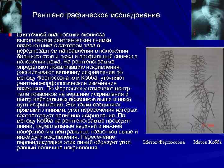 Рентгенографическое исследование Для точной диагностики сколиоза выполняются рентгеновские снимки позвоночника с захватом таза в