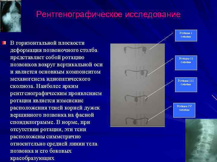 Рентгенографическое исследование Ротация 1 степени В горизонтальной плоскости деформация позвоночного столба представляет собой ротацию