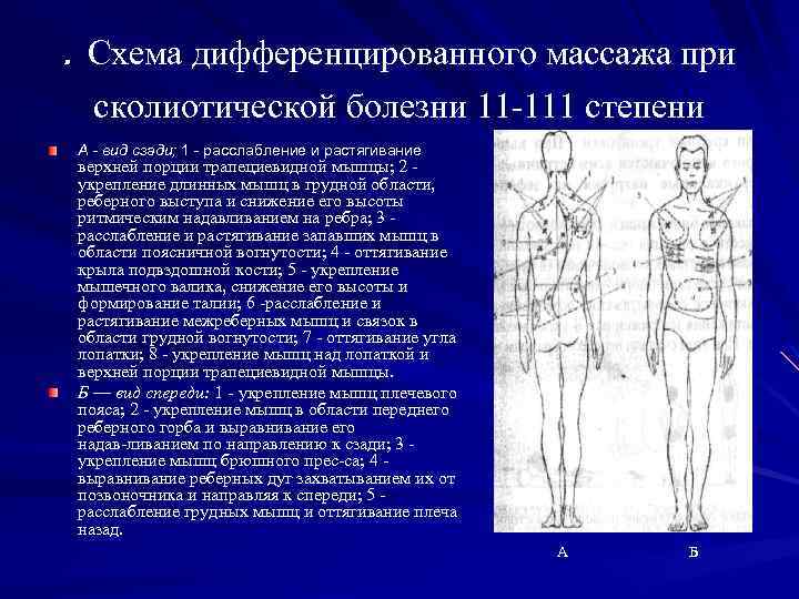 . Схема дифференцированного массажа при сколиотической болезни 11 111 степени А - вид сзади;