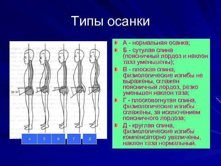 Типы осанки А Б В Г Д А нормальная осанка; Б сутулая спина (поясничный