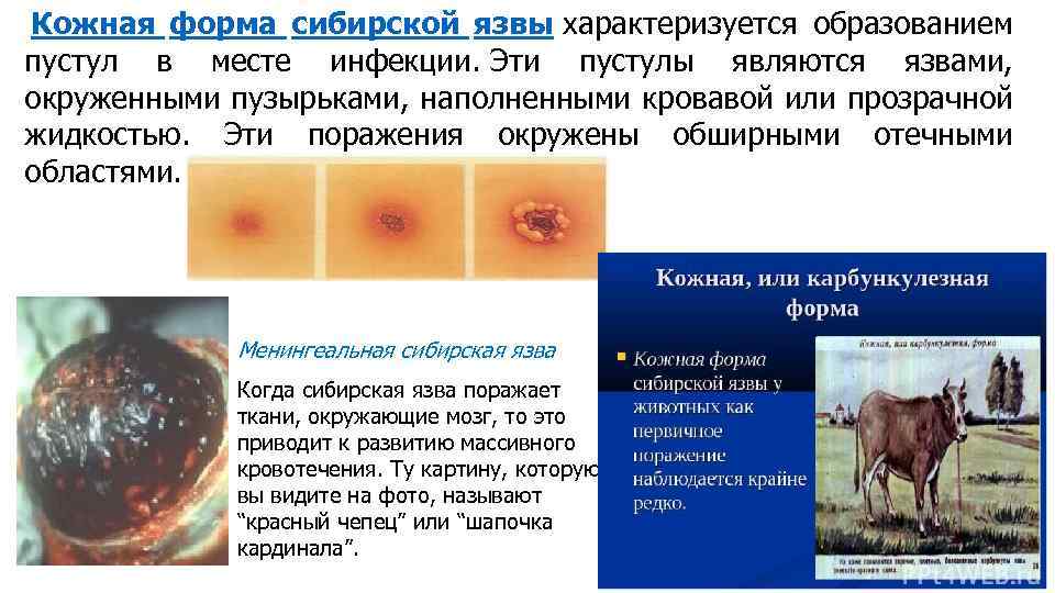  Кожная форма сибирской язвы характеризуется образованием пустул в месте инфекции. Эти пустулы являются
