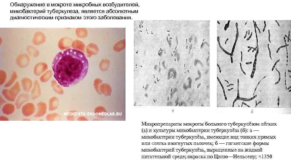 Обнаружение в мокроте микробных возбудителей, микобактерий туберкулеза, является абсолютным диагностическим признаком этого заболевания. Микропрепараты