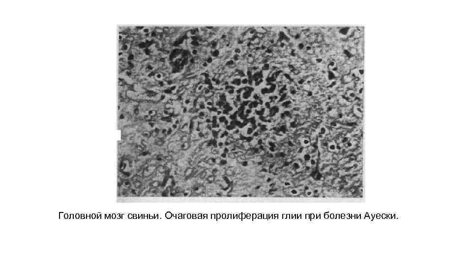 Головной мозг свиньи. Очаговая пролиферация глии при болезни Ауески. 