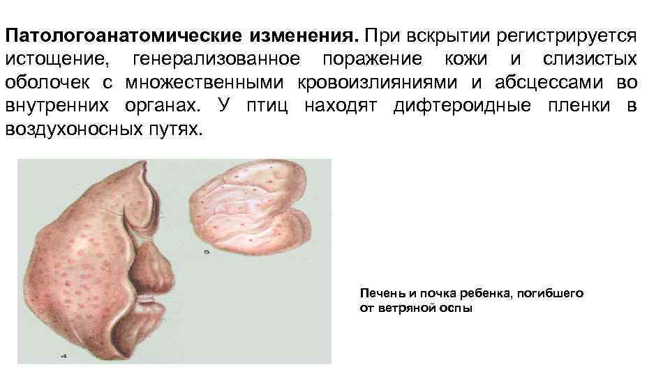 Патологоанатомические изменения. При вскрытии регистрируется истощение, генерализованное поражение кожи и слизистых оболочек с множественными