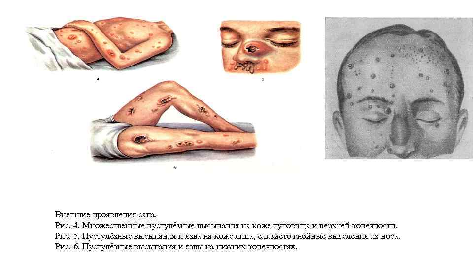 Внешние проявления сапа. Рис. 4. Множественные пустулёзные высыпания на коже туловища и верхней конечности.