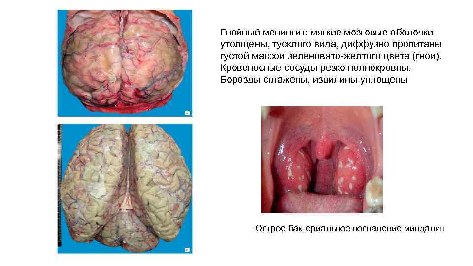 Гнойный менингит: мягкие мозговые оболочки утолщены, тусклого вида, диффузно пропитаны густой массой зеленовато-желтого цвета