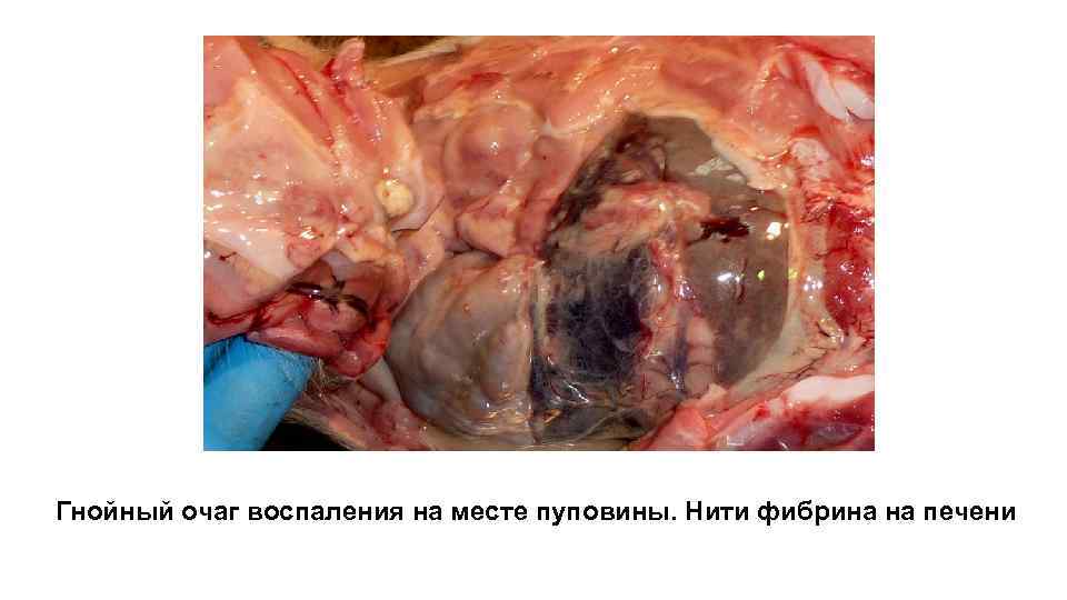 Гнойный очаг воспаления на месте пуповины. Нити фибрина на печени 