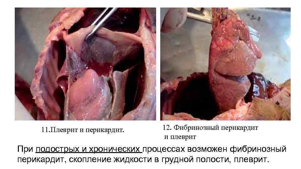 11. Плеврит и перикардит. 12. Фибринозный перикардит и плеврит При подострых и хронических процессах