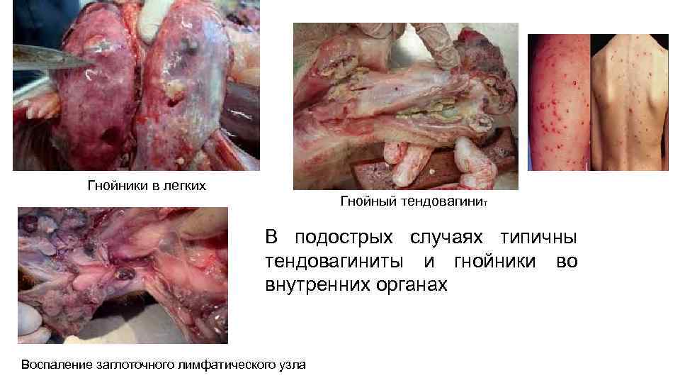  Гнойники в легких Гнойный тендовагинит В подострых случаях типичны тендовагиниты и гнойники во